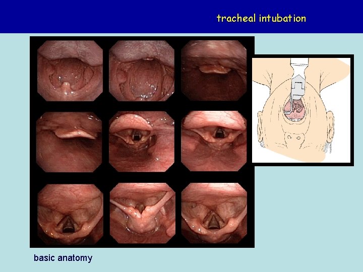 tracheal intubation basic anatomy 