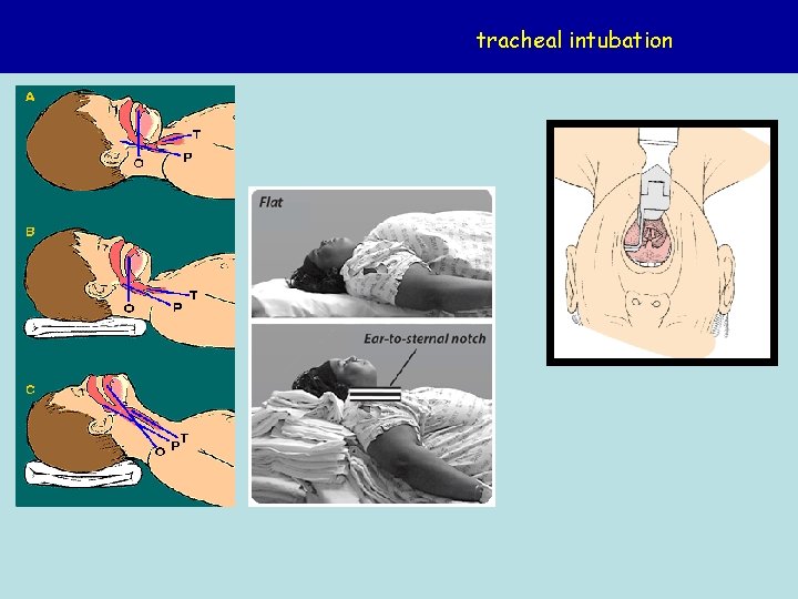 tracheal intubation 