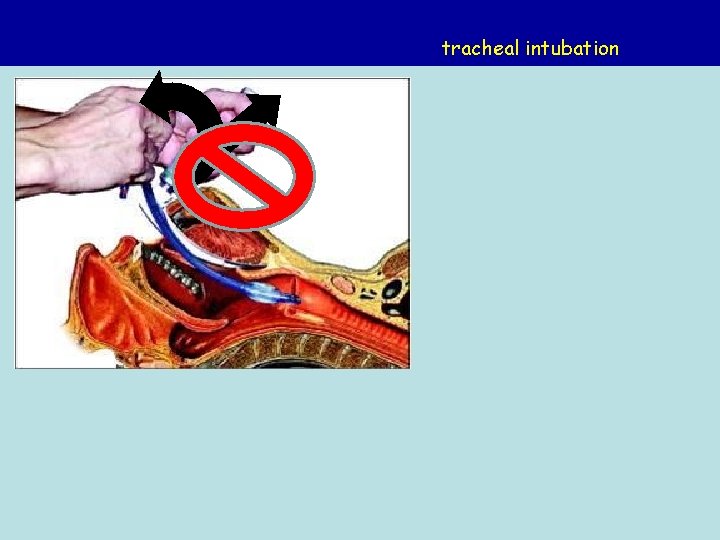 tracheal intubation 