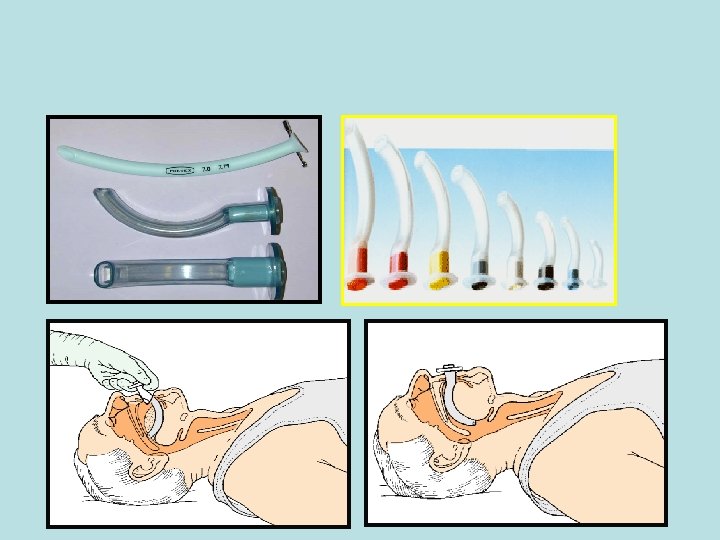 Techniques Equipment in basic airway management The ABCDE