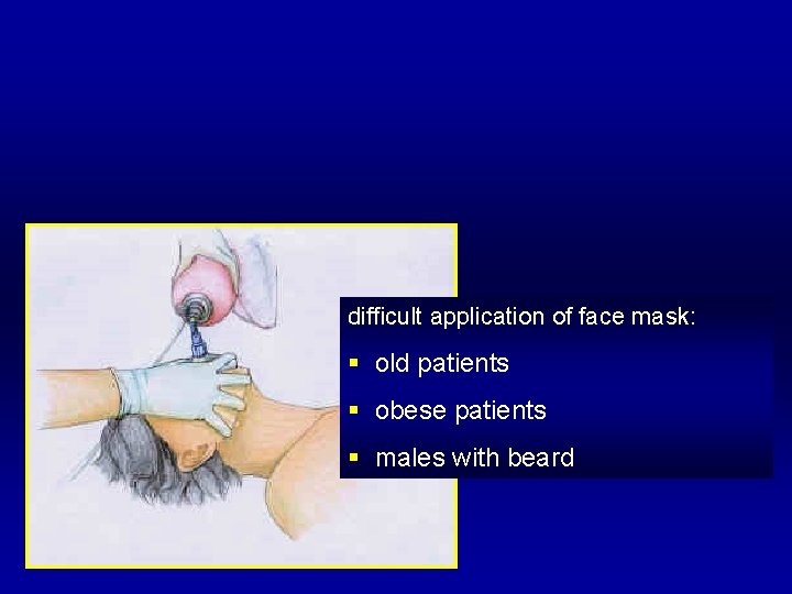 difficult application of face mask: § old patients § obese patients § males with