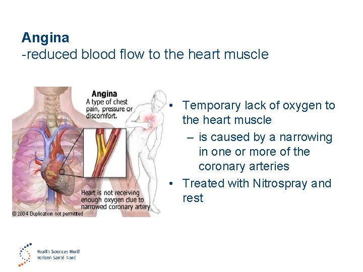 Angina -reduced blood flow to the heart muscle • Temporary lack of oxygen to