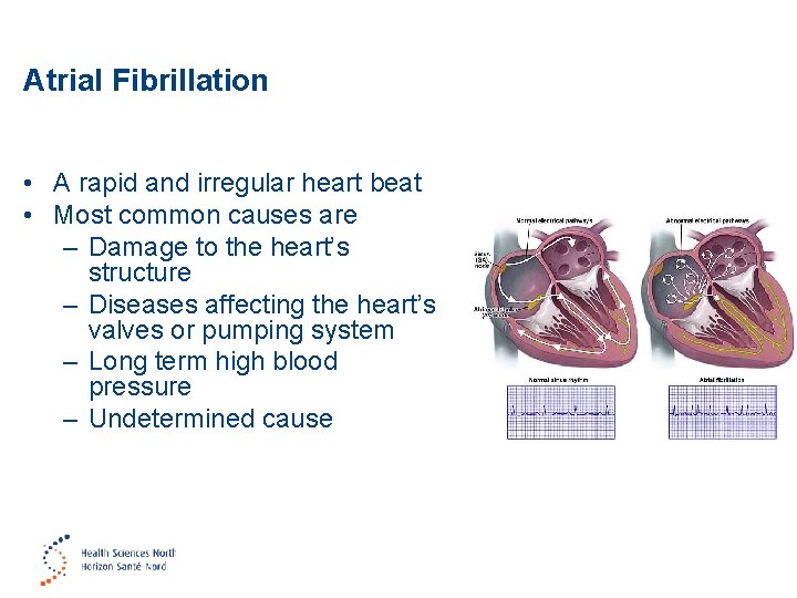Atrial Fibrillation • A rapid and irregular heart beat • Most common causes are