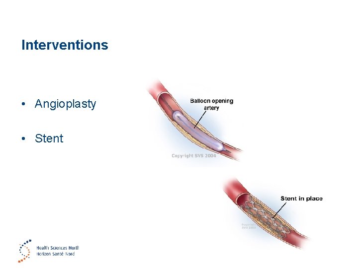 Interventions • Angioplasty • Stent 