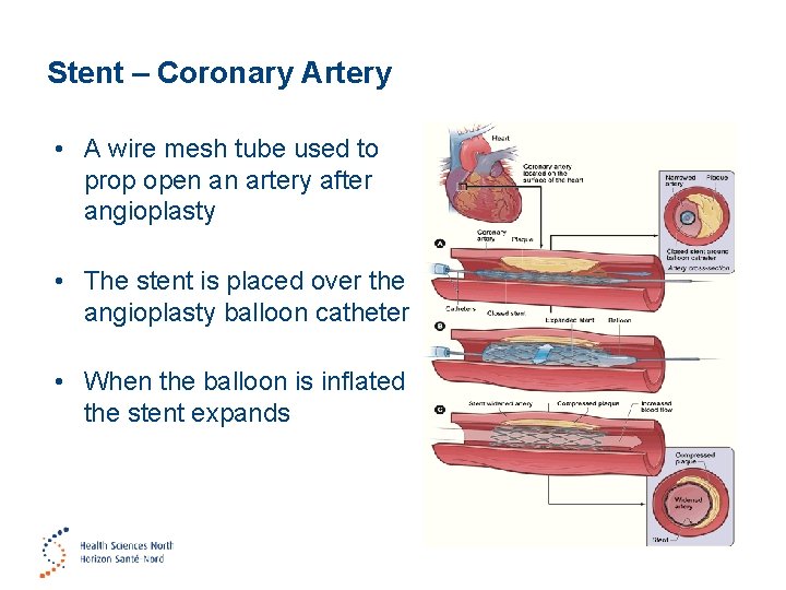 Stent – Coronary Artery • A wire mesh tube used to prop open an