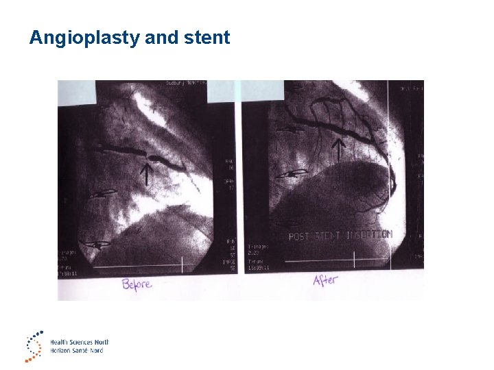 Angioplasty and stent 