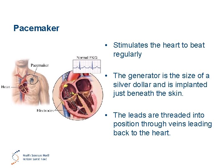 Pacemaker • Stimulates the heart to beat regularly • The generator is the size