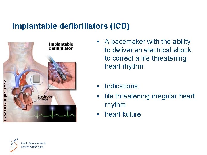 Implantable defibrillators (ICD) • A pacemaker with the ability to deliver an electrical shock