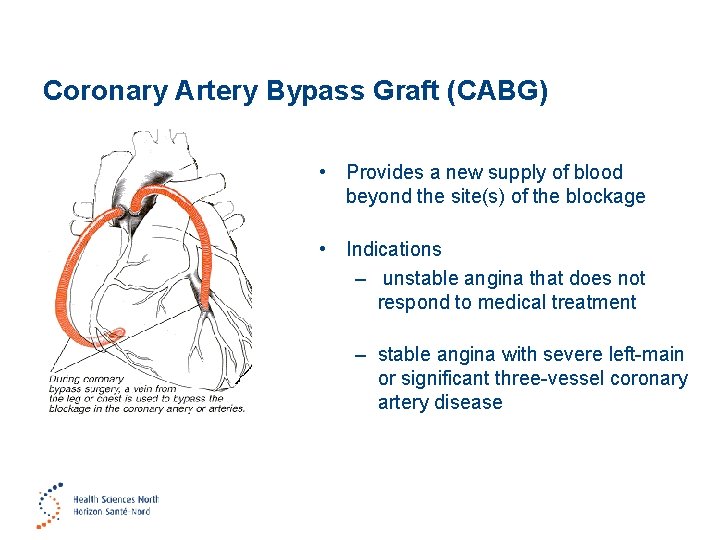 Coronary Artery Bypass Graft (CABG) • Provides a new supply of blood beyond the