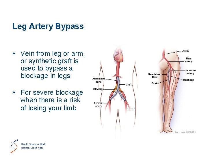 Leg Artery Bypass • Vein from leg or arm, or synthetic graft is used