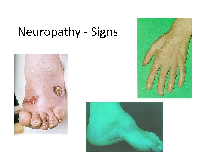 Neuropathy - Signs 