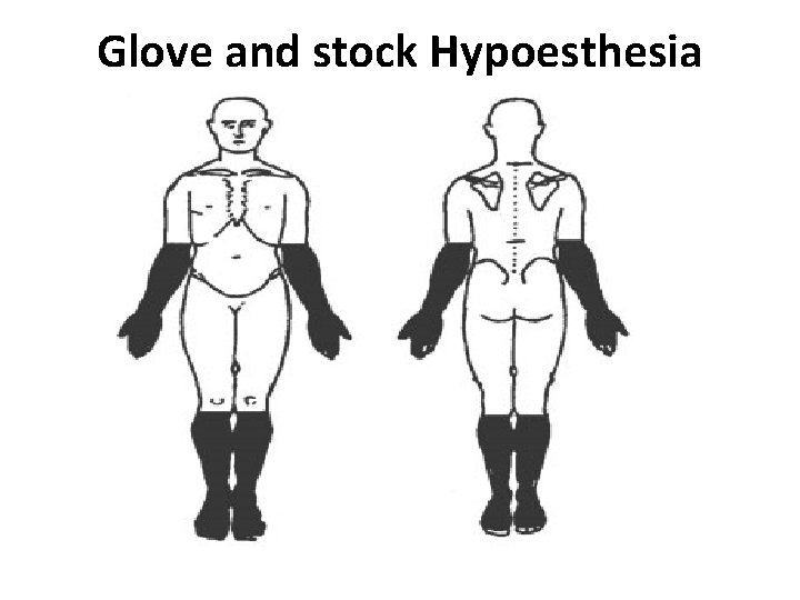 Glove and stock Hypoesthesia 