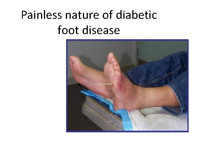 Painless nature of diabetic foot disease 