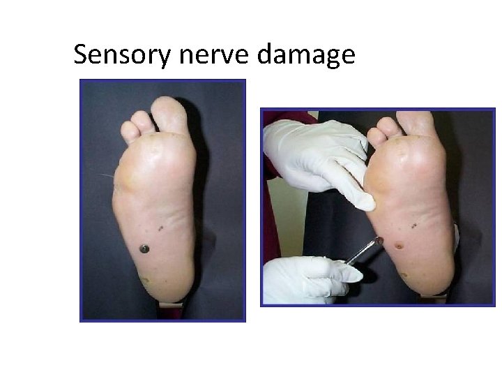 Sensory nerve damage 