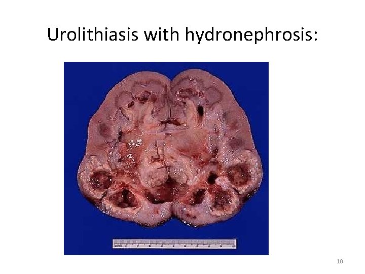 Urolithiasis with hydronephrosis: 10 