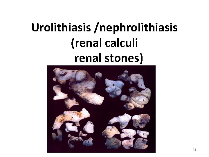 Urolithiasis /nephrolithiasis (renal calculi renal stones) 11 