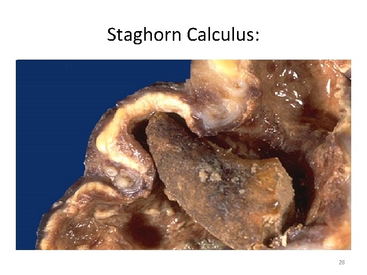 Staghorn Calculus: 28 