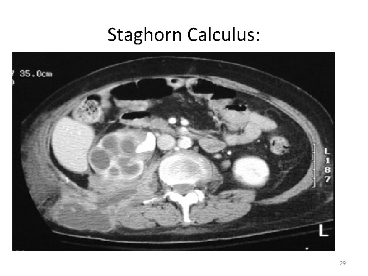 Staghorn Calculus: 29 