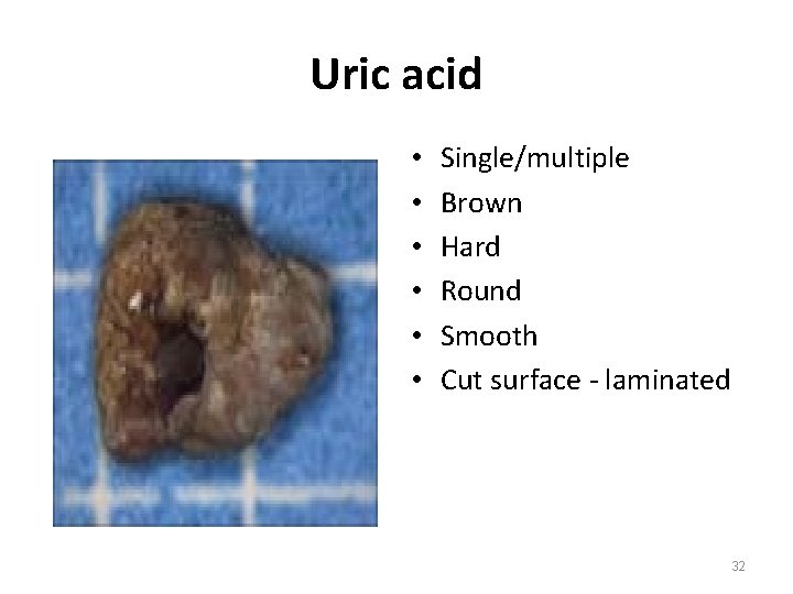 Uric acid • • • Single/multiple Brown Hard Round Smooth Cut surface - laminated