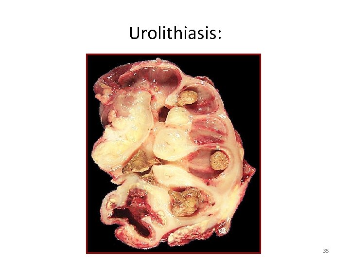 Urolithiasis: 35 