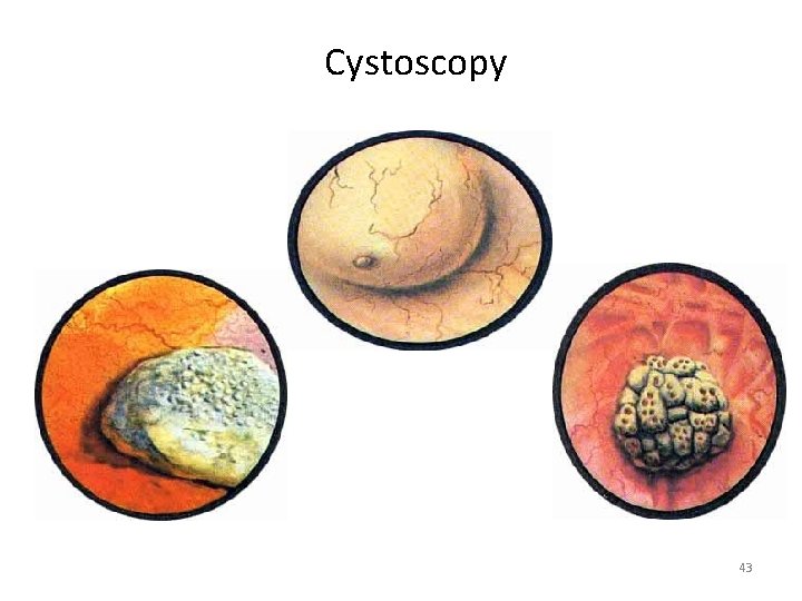 Cystoscopy 43 