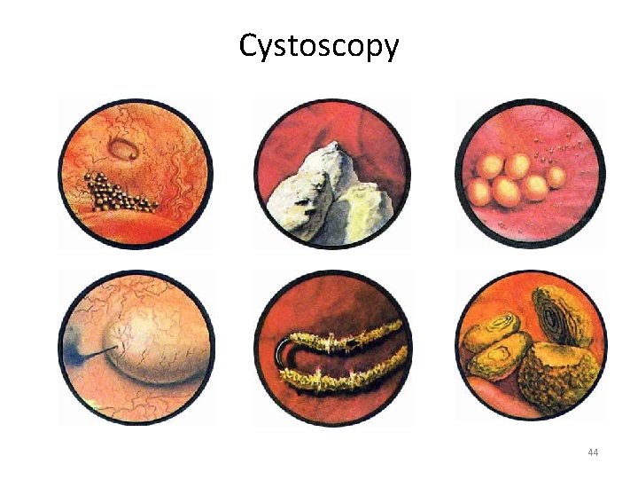 Cystoscopy 44 