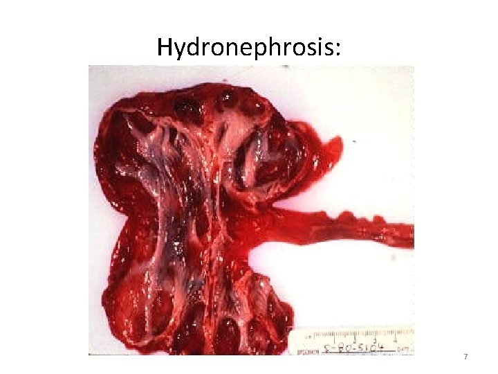 Hydronephrosis: 7 