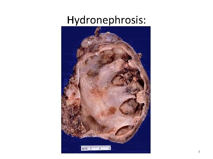 Hydronephrosis: 8 