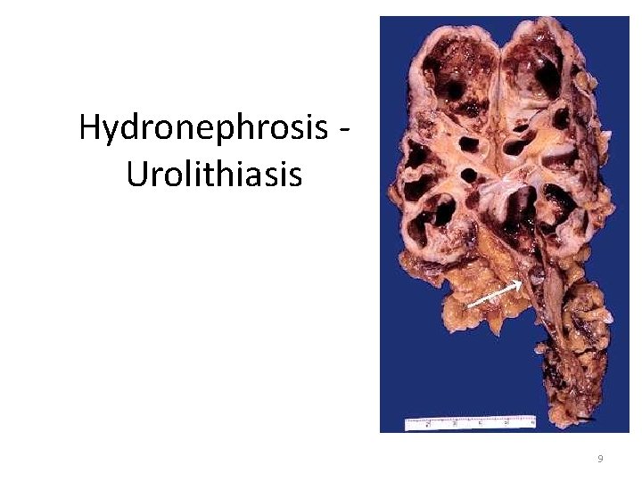 Hydronephrosis Urolithiasis 9 