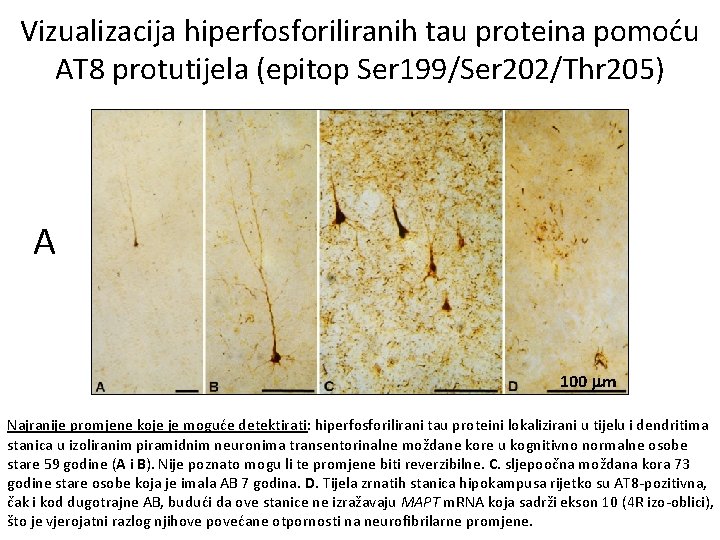 Vizualizacija hiperfosforiliranih tau proteina pomoću AT 8 protutijela (epitop Ser 199/Ser 202/Thr 205) A