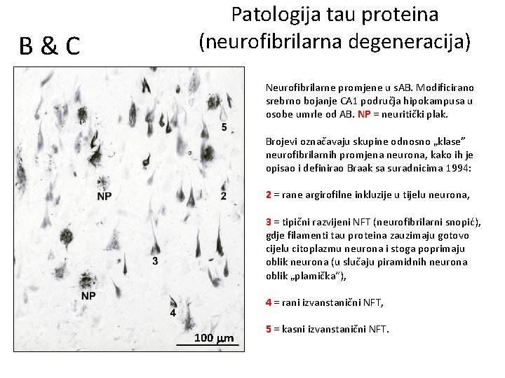 B&C Patologija tau proteina (neurofibrilarna degeneracija) Neurofibrilarne promjene u s. AB. Modificirano srebrno bojanje