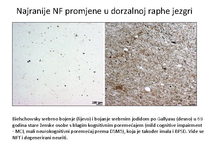 Najranije NF promjene u dorzalnoj raphe jezgri 100 m Bielschowsky srebrno bojenje (lijevo) i