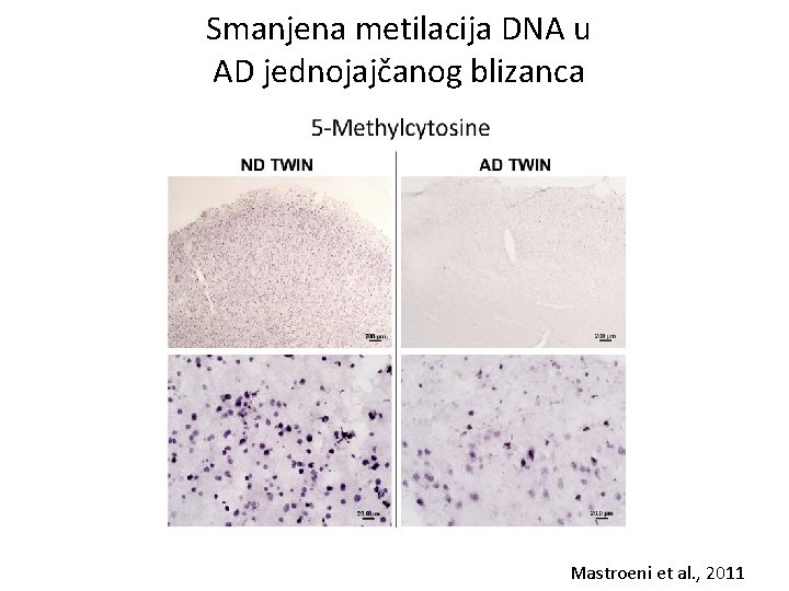 Smanjena metilacija DNA u AD jednojajčanog blizanca Mastroeni et al. , 2011 