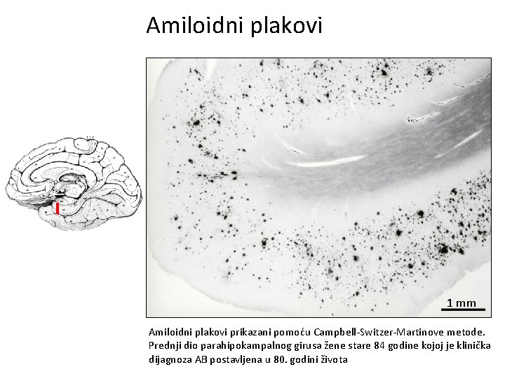 Amiloidni plakovi 1 mm Amiloidni plakovi prikazani pomoću Campbell-Switzer-Martinove metode. Prednji dio parahipokampalnog girusa