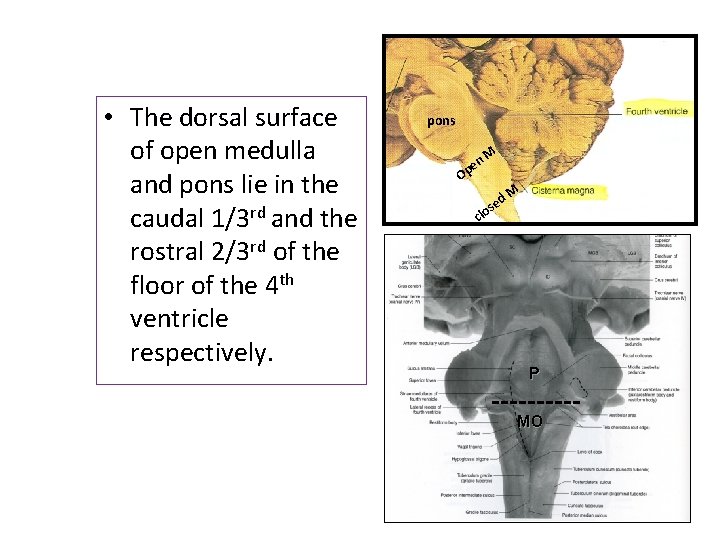  • The dorsal surface of open medulla and pons lie in the caudal