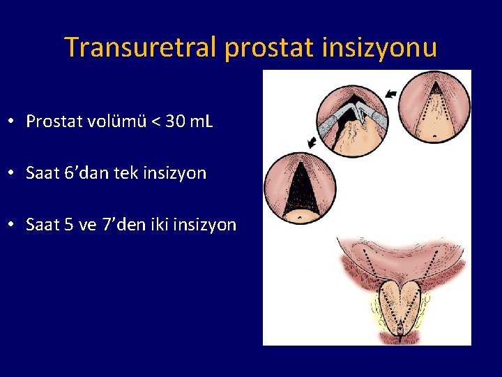 Transuretral prostat insizyonu • Prostat volümü < 30 m. L • Saat 6’dan tek