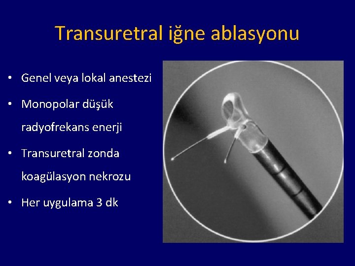 Transuretral iğne ablasyonu • Genel veya lokal anestezi • Monopolar düşük radyofrekans enerji •
