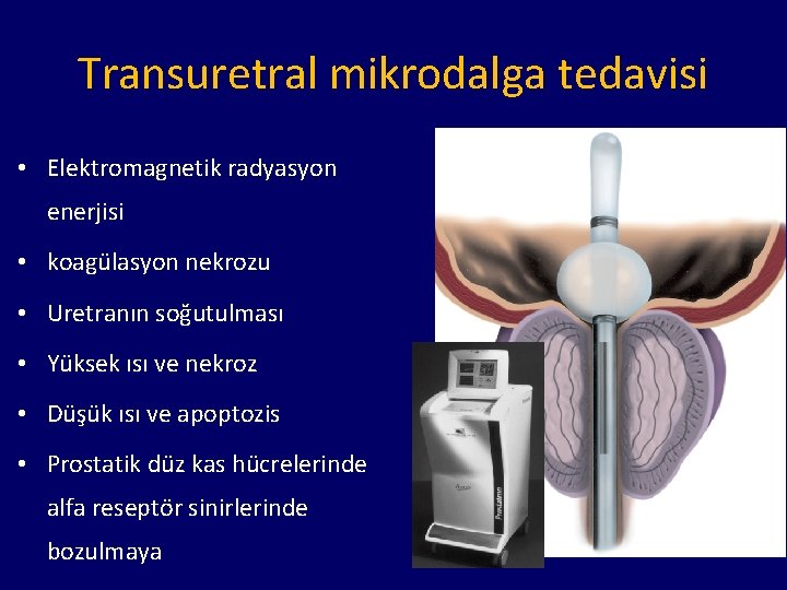 Transuretral mikrodalga tedavisi • Elektromagnetik radyasyon enerjisi • koagülasyon nekrozu • Uretranın soğutulması •