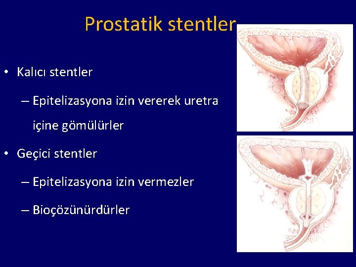Prostatik stentler • Kalıcı stentler – Epitelizasyona izin vererek uretra içine gömülürler • Geçici