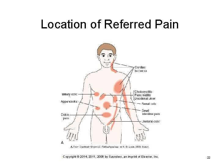 Location of Referred Pain • Copyright © 2014, 2011, 2006 by Saunders, an imprint