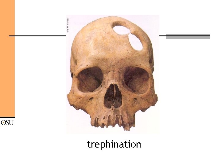 trephination 