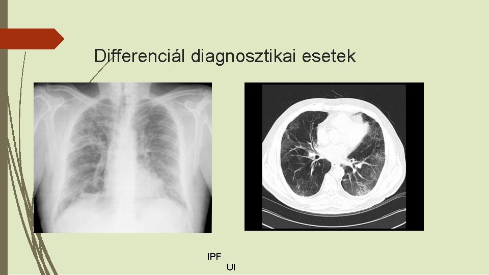 Differenciál diagnosztikai esetek IPF UI 