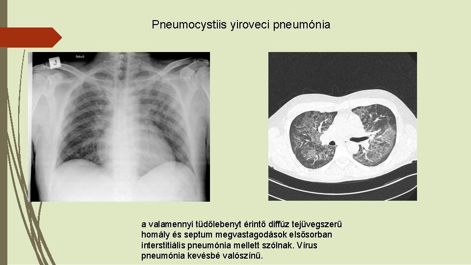 Pneumocystiis yiroveci pneumónia a valamennyi tüdőlebenyt érintő diffúz tejüvegszerű homály és septum megvastagodások elsősorban