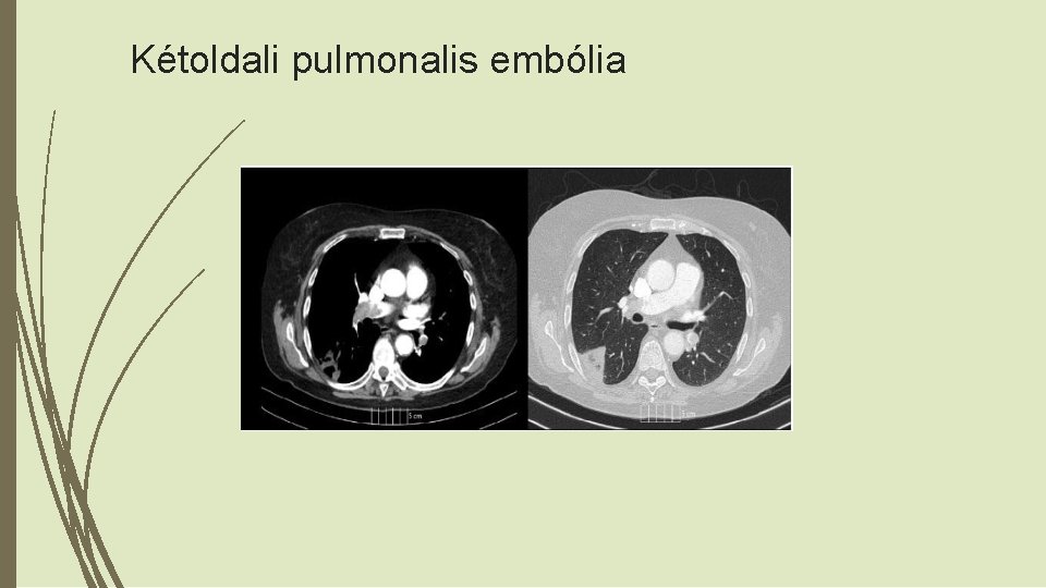 Kétoldali pulmonalis embólia 