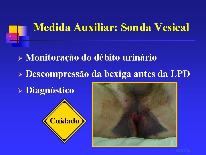 Medida Auxiliar: Sonda Vesical Ø Monitoração do débito urinário Ø Descompressão da bexiga antes