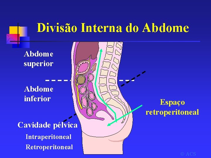 Divisão Interna do Abdome superior Abdome inferior Espaço retroperitoneal Cavidade pélvica Intraperitoneal Retroperitoneal ACS