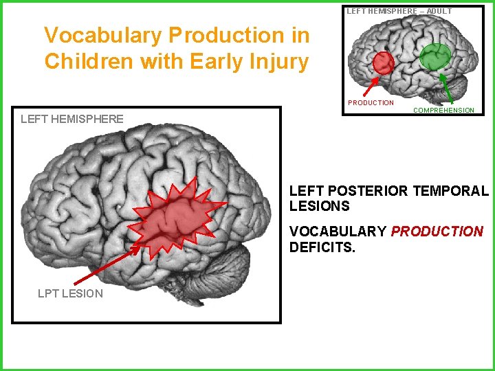 LEFT HEMISPHERE – ADULT Vocabulary Production in Children with Early Injury PRODUCTION LEFT HEMISPHERE