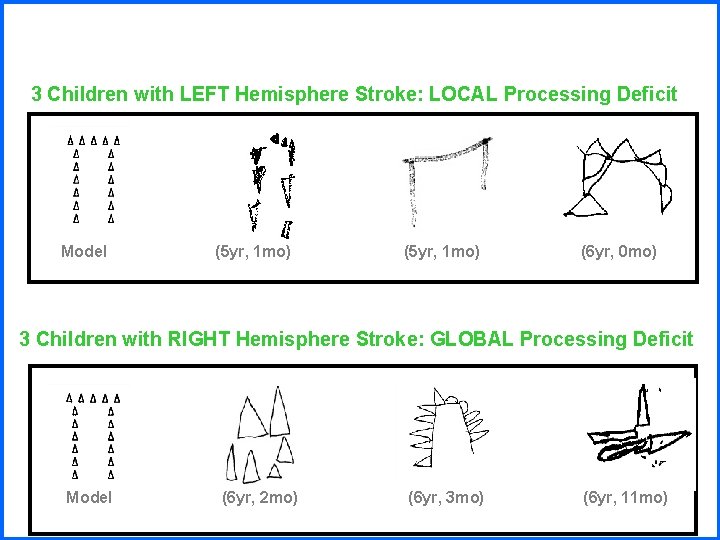 3 Children with LEFT Hemisphere Stroke: LOCAL Processing Deficit Model (5 yr, 1 mo)