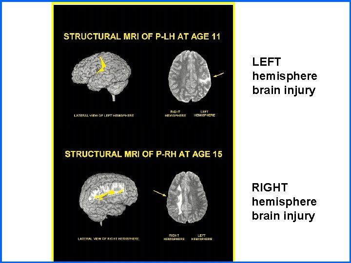 LEFT hemisphere brain injury RIGHT hemisphere brain injury 