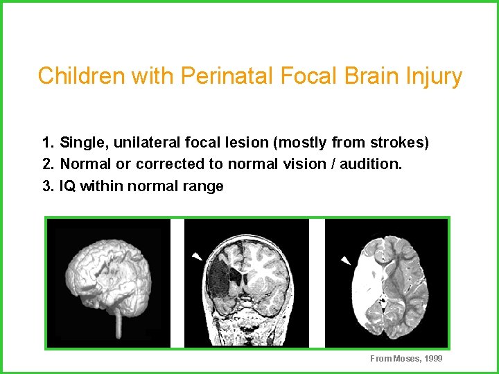 Children with Perinatal Focal Brain Injury 1. Single, unilateral focal lesion (mostly from strokes)